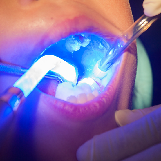 Child dental patient receiving dental sealants