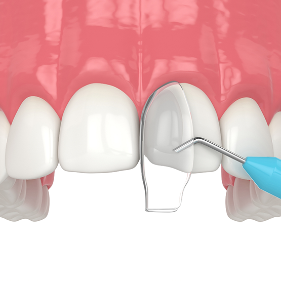 Illustrated bonding material being applied to a tooth