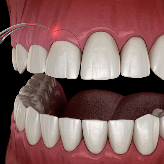 Illustrated dental laser correcting a gummy smile