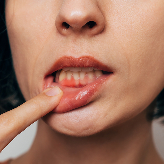 Close up of person revealing red spot in their gums