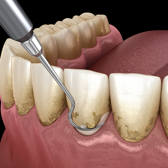 Illustrated dental scaler clearing plaque buildup