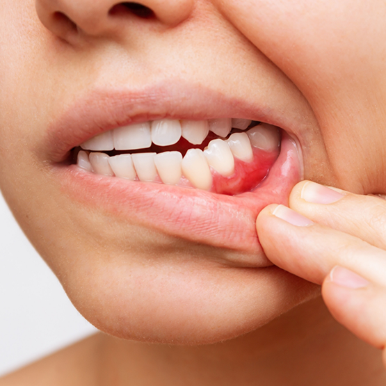 Close up of person revealing red spot in their gums