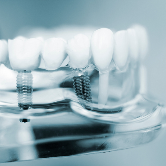 Model of the mouth with two dental implants