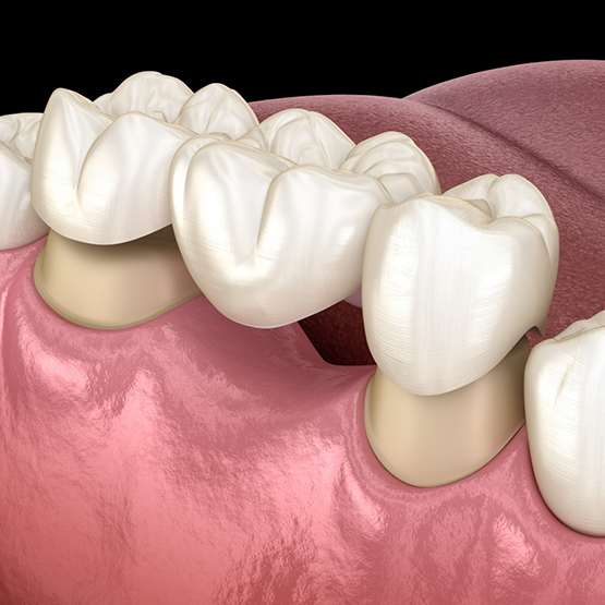 Illustrated dental bridge being placed to replace a missing tooth