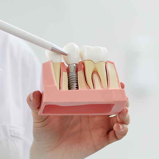 Dentist pointing to a model of a dental implant