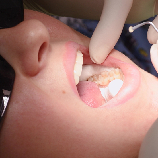 Close up of a dental patient getting a tooth colored filling