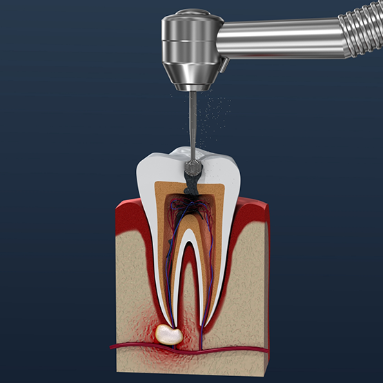 Illustrated dental instrument treating the inside of a tooth