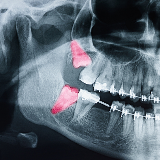 X ray of mouth with two impacted wisdom teeth highlighted red