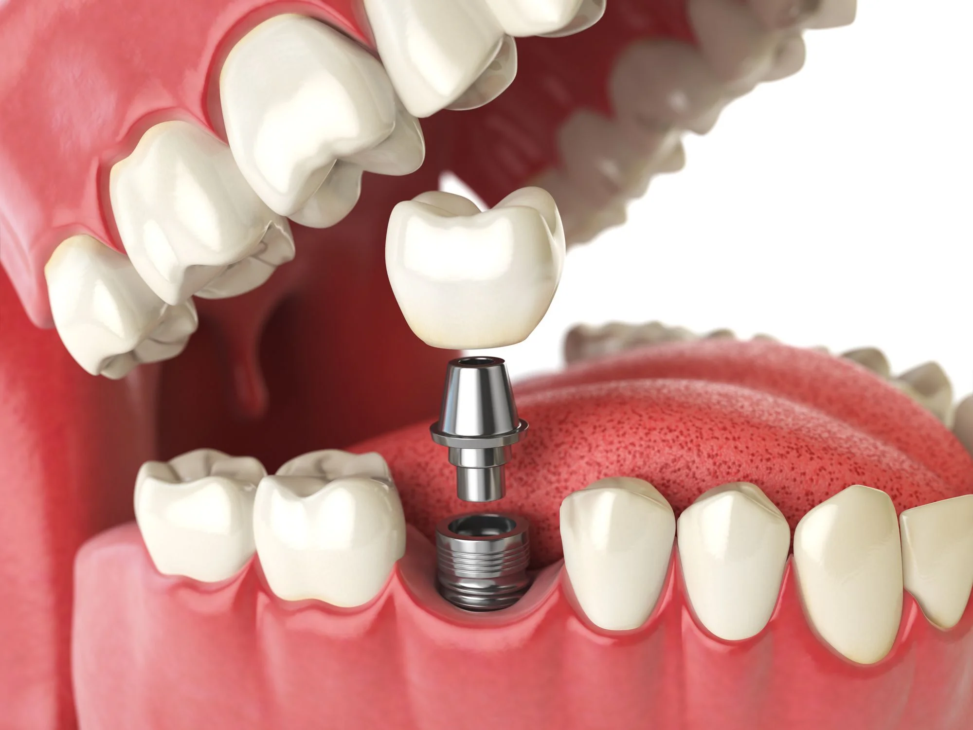 Considering Dental Implants in Arleta?
